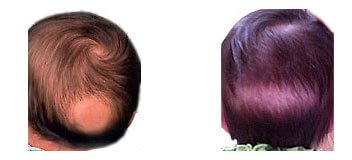 Circular & Long hair spot